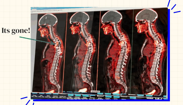 图 | 西德手术前后的癌症照片，从右至左展示了癌细胞的进展情况（来源：西德）
