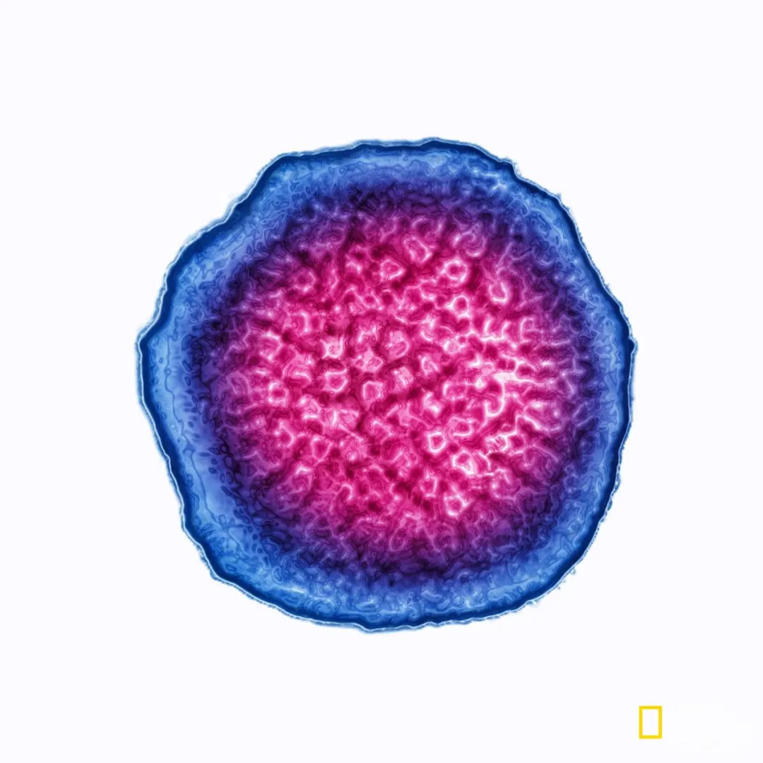 几乎人人得过的病毒，竟能诱发红斑狼疮？