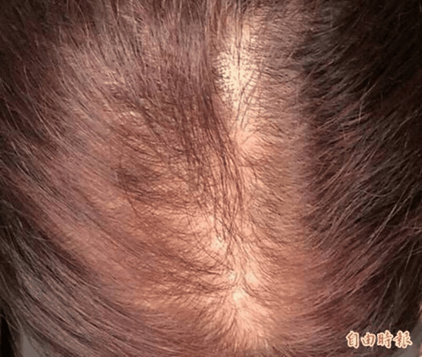 研究指出，人类外观特征仍持续受基因演化影响，其中与男性型秃头相关的基因比例可能出现变化。 （资料照）