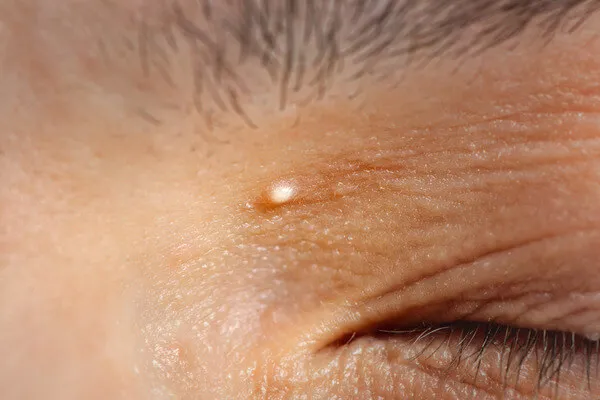 粟丘疹（来源：参考文献[5]）