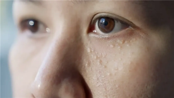 汗管瘤（来源：参考文献[6]）