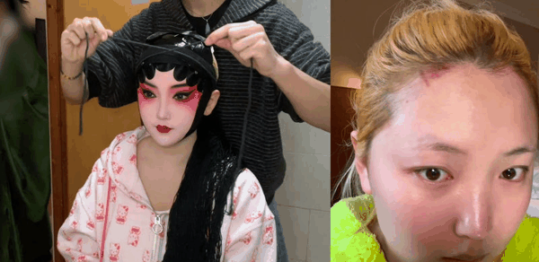 圆子最多的一天勒了16个半小时的头，起了一堆水泡。 受访者供图