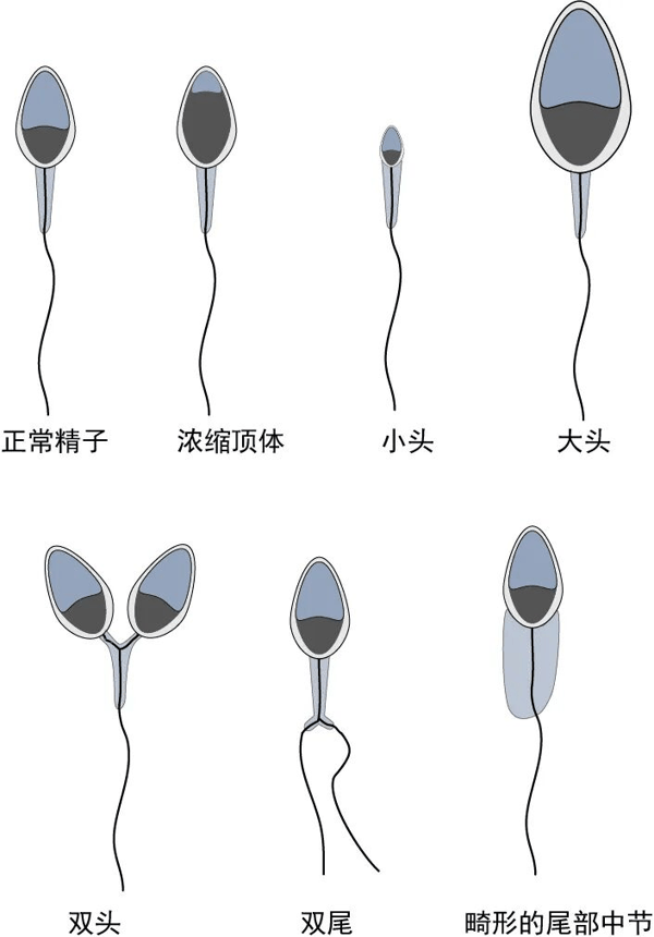 （图：维基百科）个别时候还会出现畸形精子，畸形会影响精子的运动能力，也没办法到最后一步