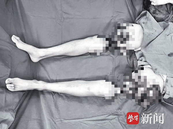 接诊时江先生双大腿已完全离断。