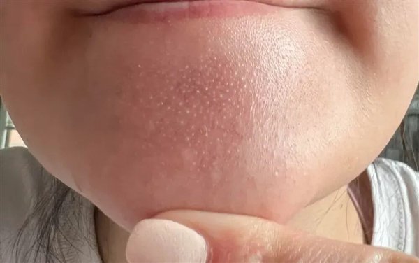 图 4. 主要是正常的毛囊皮脂腺，极个别是脂质微丝（来自：参考文献[6]）